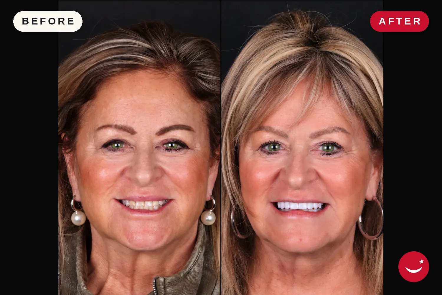 E.max crowns in Turkey: before and after at Doctor Turka