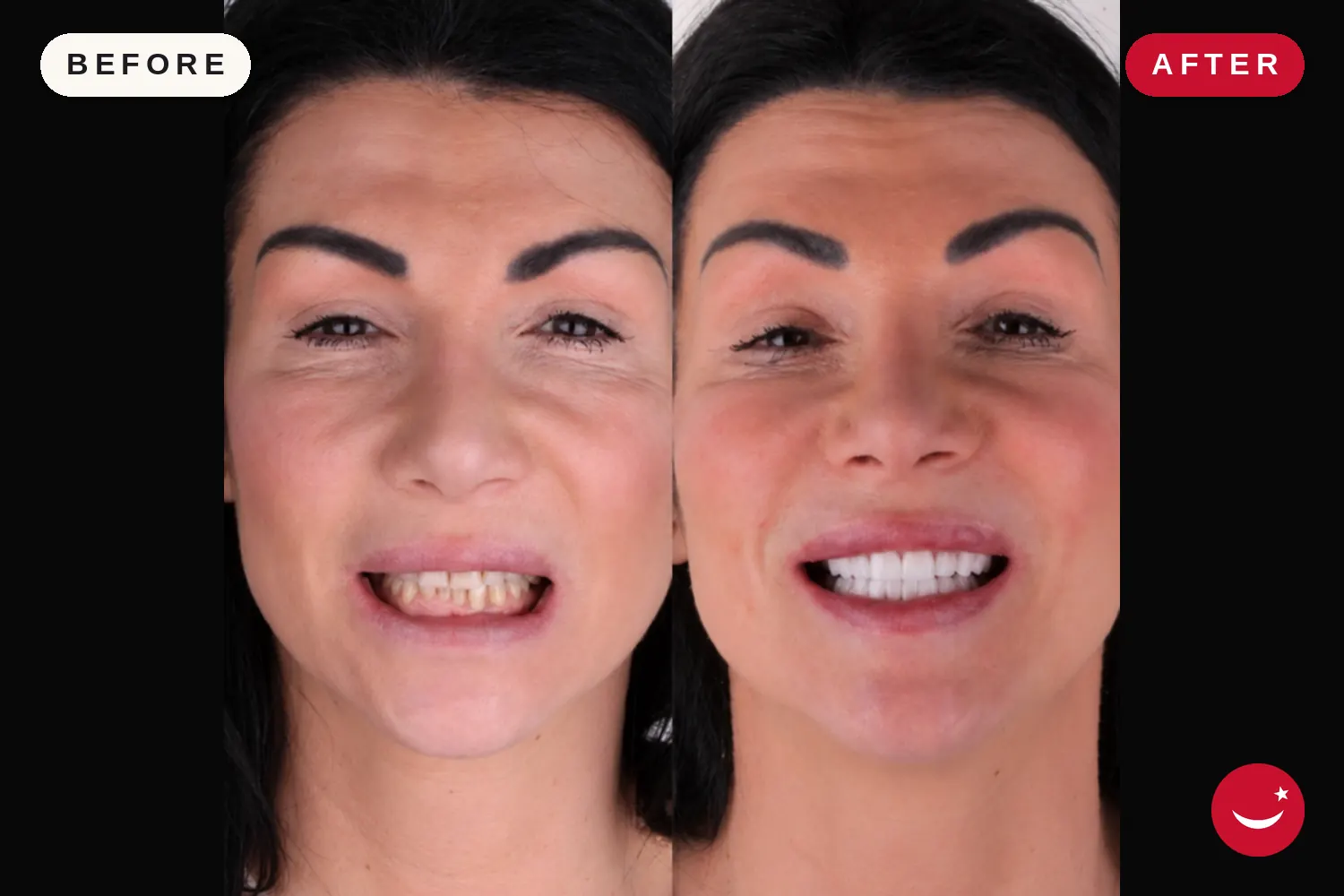 Porcelain veneers in Turkey: before and after at Doctor Turka