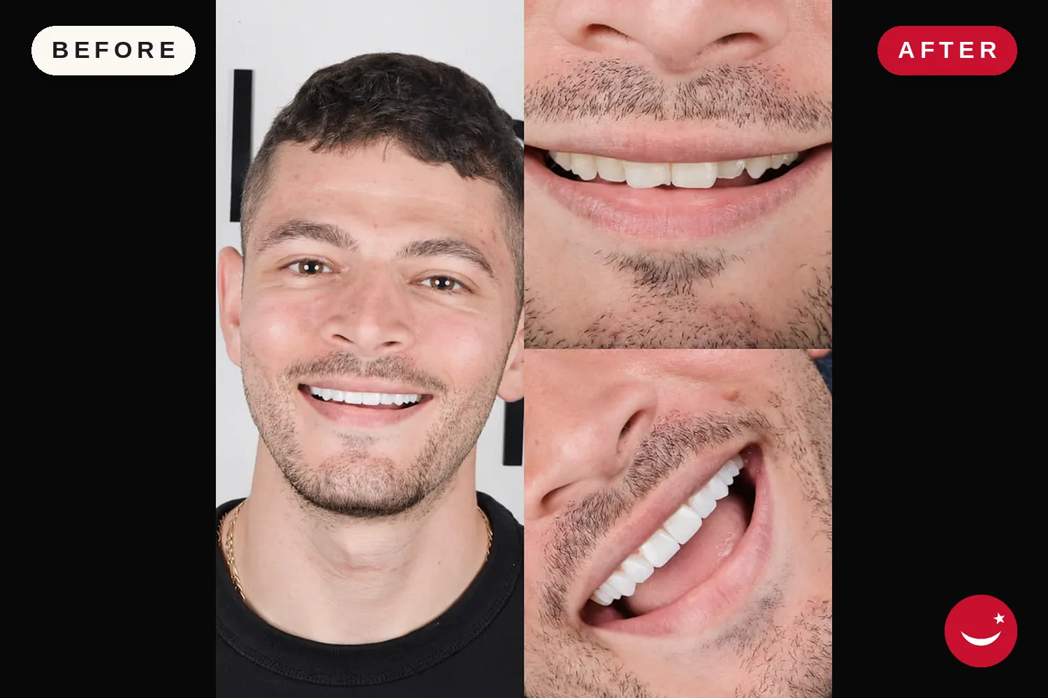 Porcelain veneers in Turkey: before and after at Doctor Turka