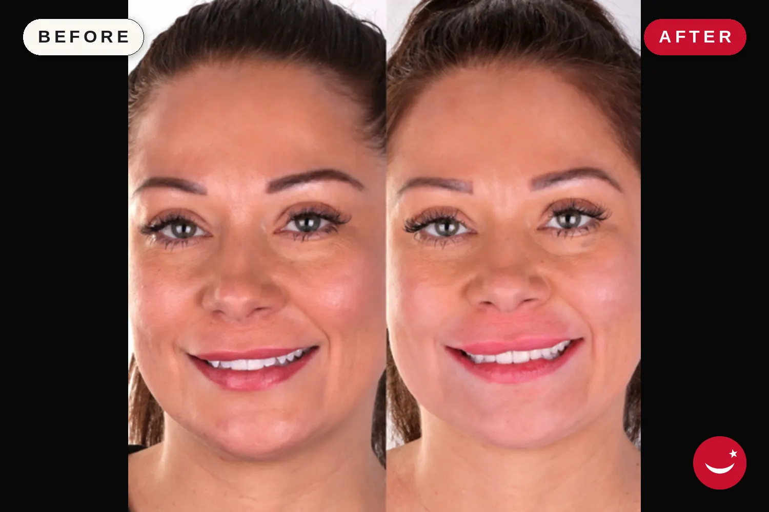 Porcelain veneers in Turkey: before and after at Doctor Turka
