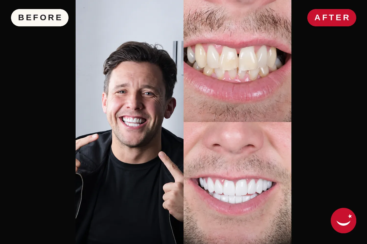 Porcelain veneers in Turkey: before and after at Doctor Turka