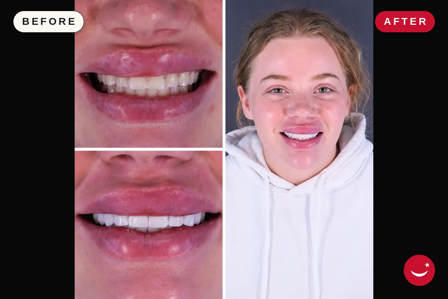 Porcelain veneers in Turkey: before and after at Doctor Turka
