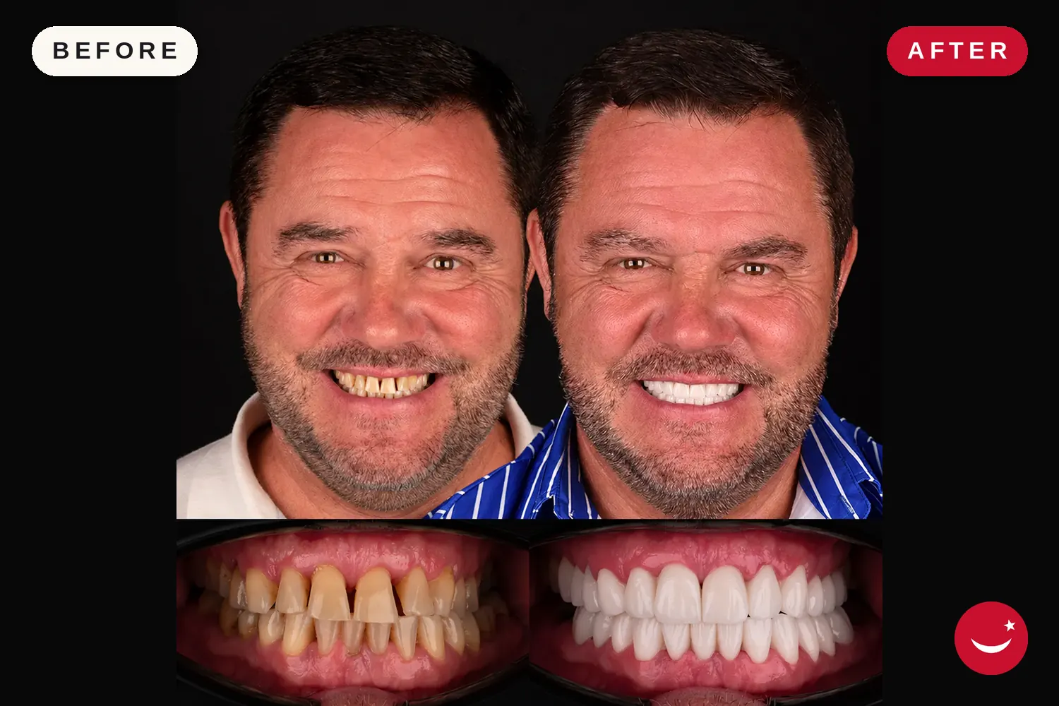 Porcelain veneers in Turkey: before and after at Doctor Turka