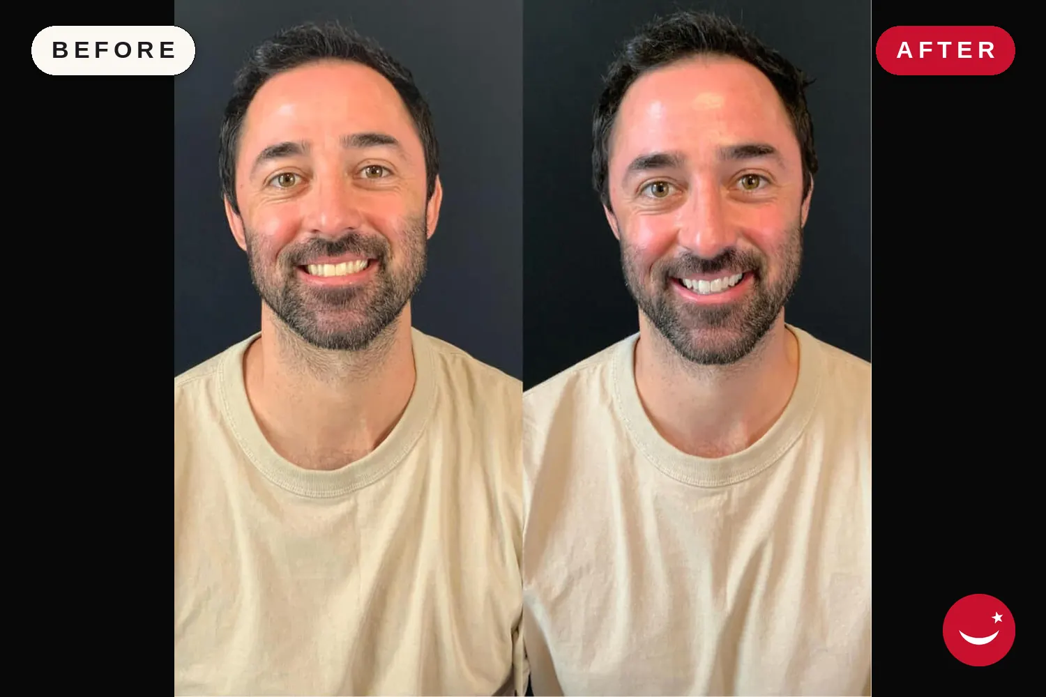 Teeth whitening in Turkey: before and after at Doctor Turka