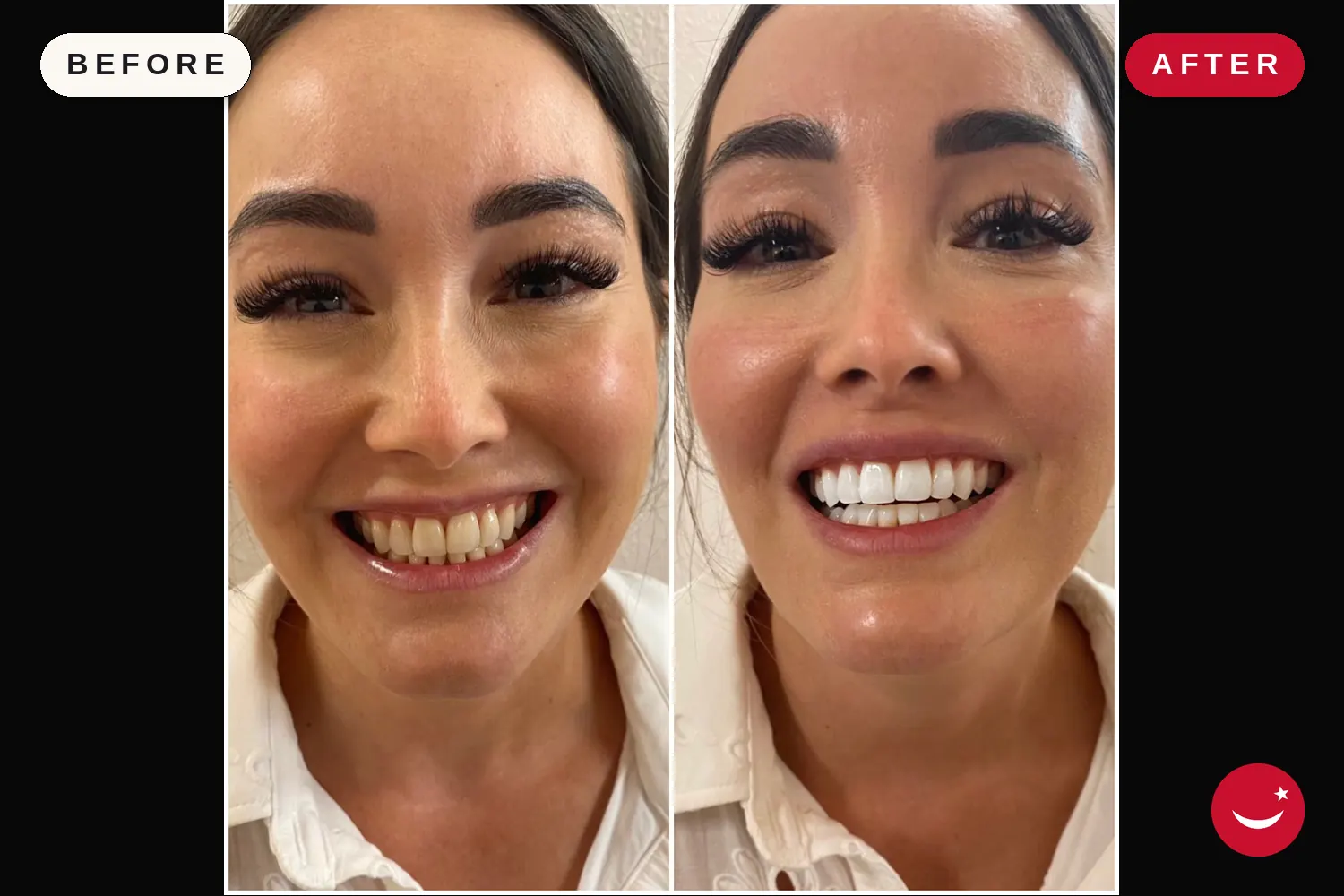 Teeth whitening in Turkey: before and after at Doctor Turka