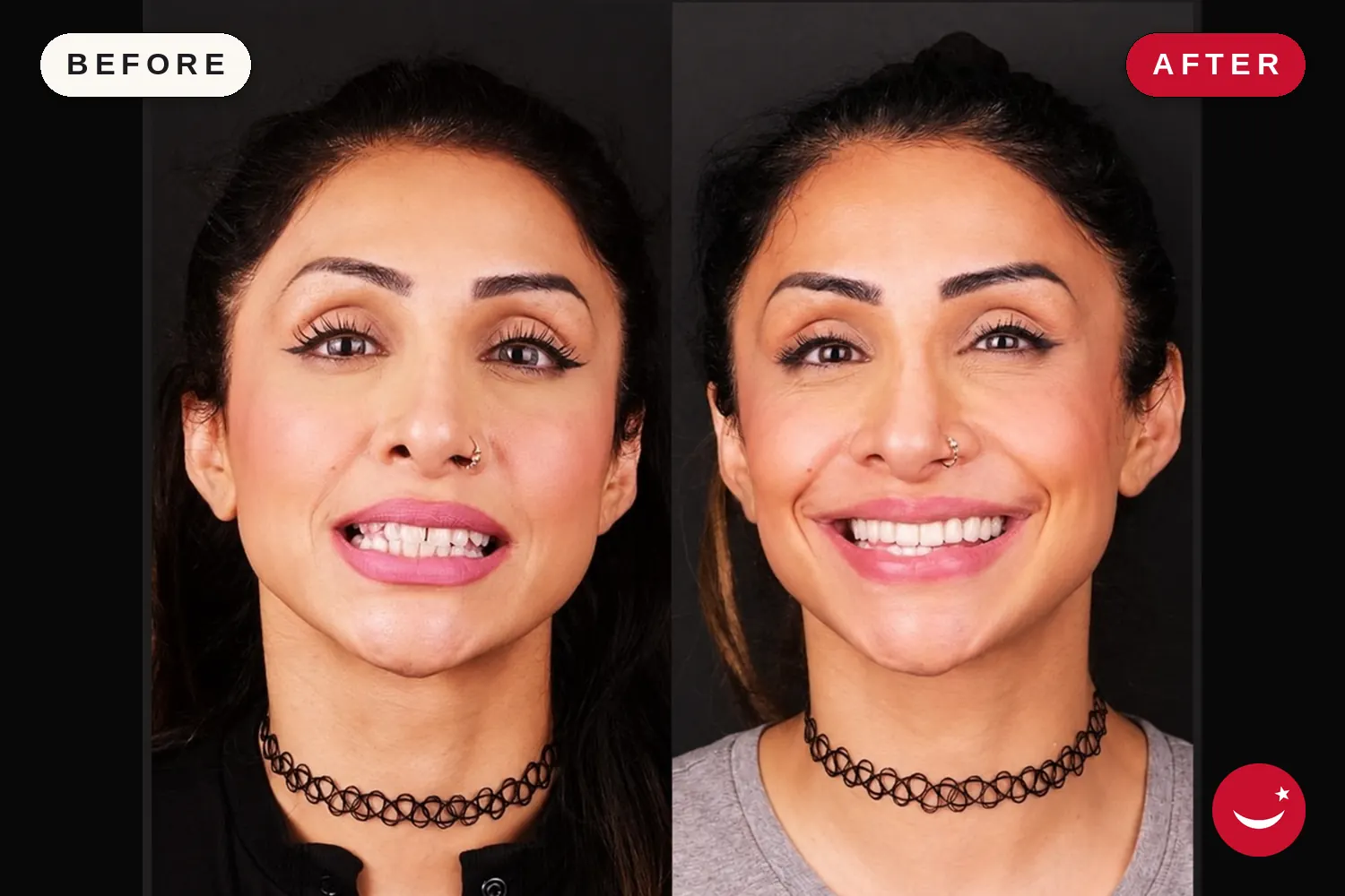 Zirconia crowns in Turkey: before and after at Doctor Turka