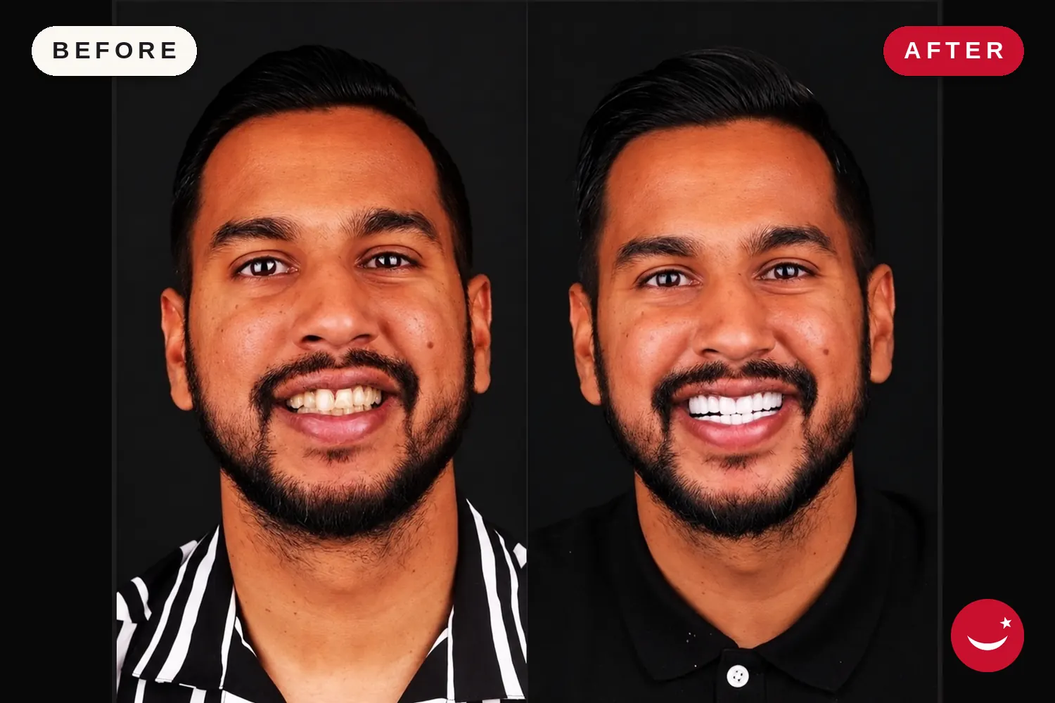 Zirconia crowns in Turkey: before and after at Doctor Turka