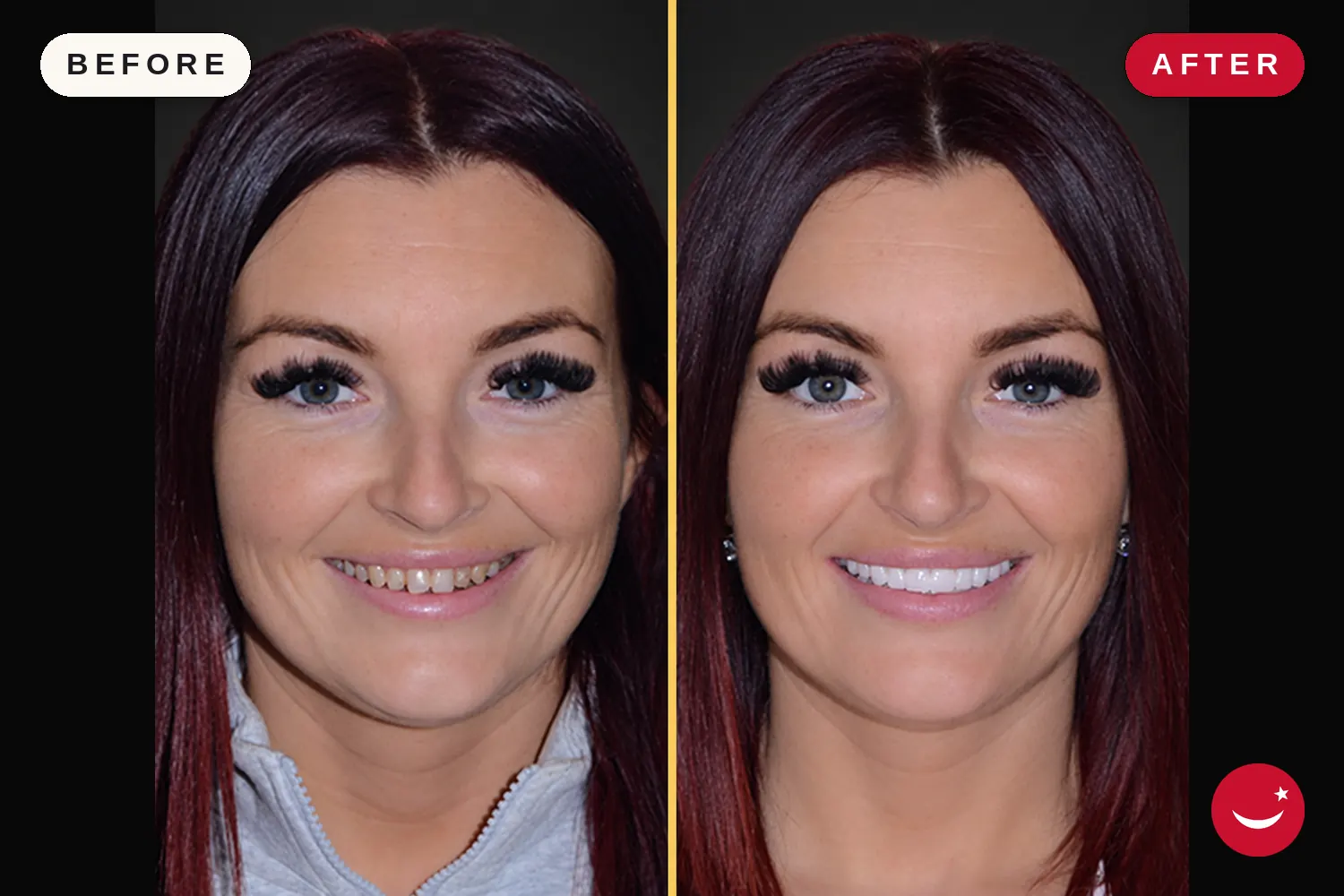 Zirconia crowns in Turkey: before and after at Doctor Turka