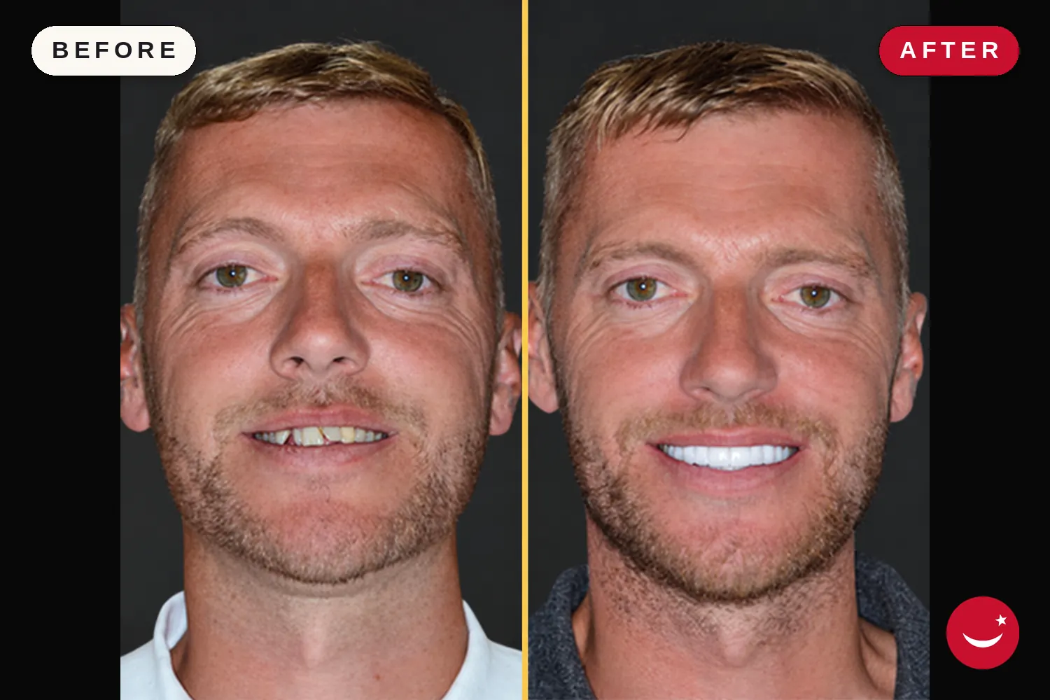 Zirconia crowns in Turkey: before and after at Doctor Turka