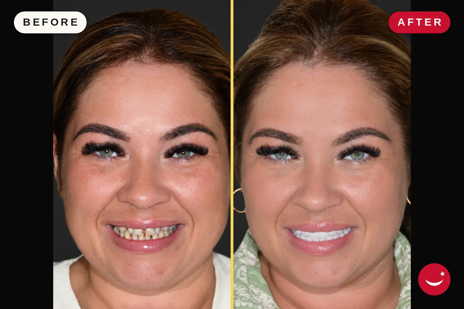 Zirconia crowns in Turkey: before and after at Doctor Turka