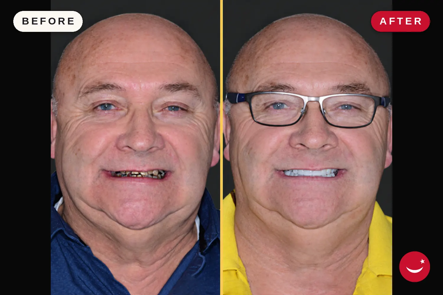 Zirconia crowns in Turkey: before and after at Doctor Turka