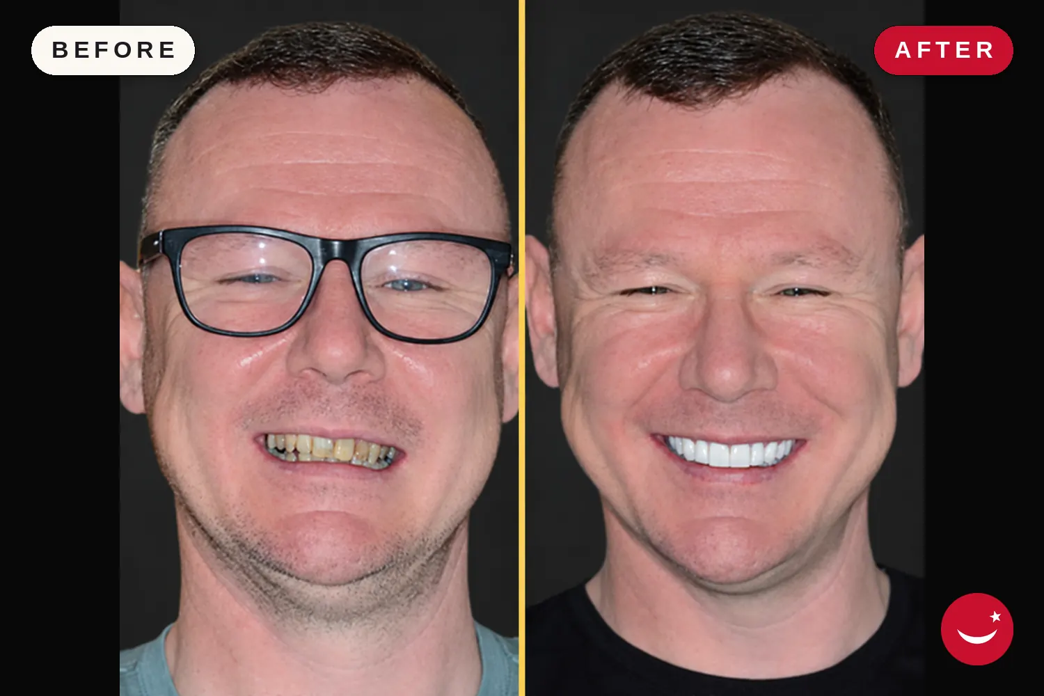 Zirconia crowns in Turkey: before and after at Doctor Turka