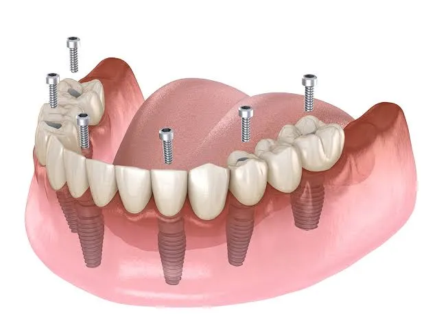 All-on-4 Dental Implants