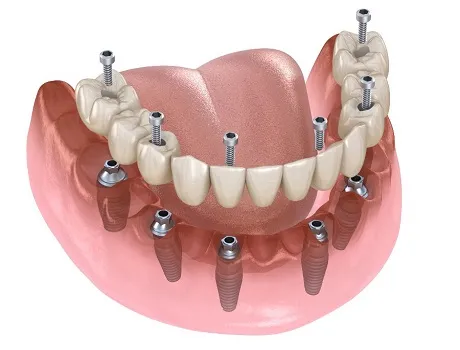 All-on-6 Dental Implants