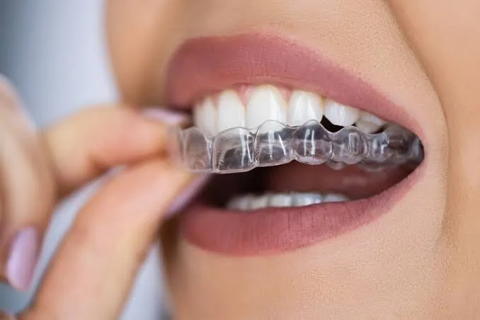 Clear Aligners & Orthodontics