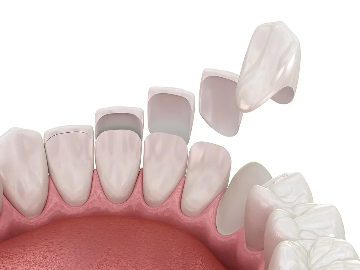 Composite Veneers & Bonding