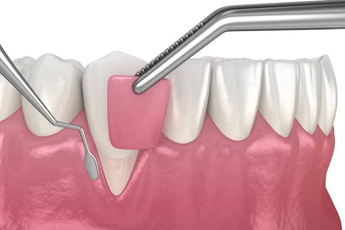 Gum Treatment & Gum Contouring