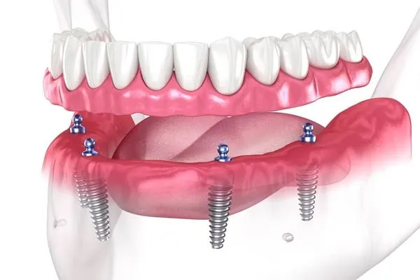 Implant-Supported Dentures
