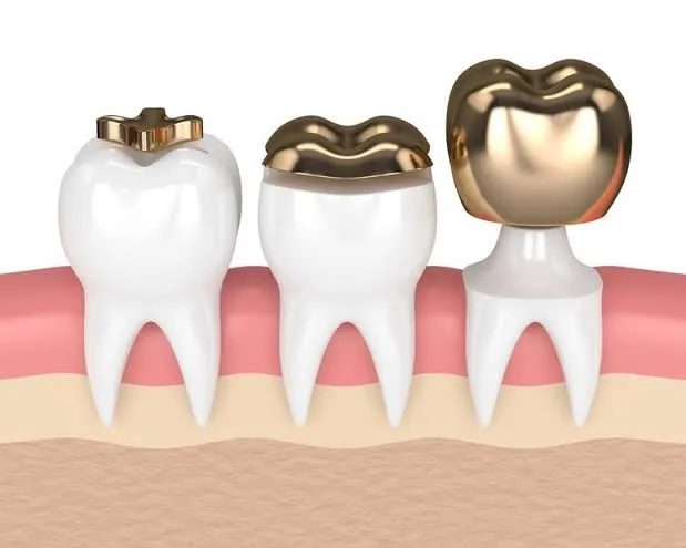Ceramic Inlays & Onlays