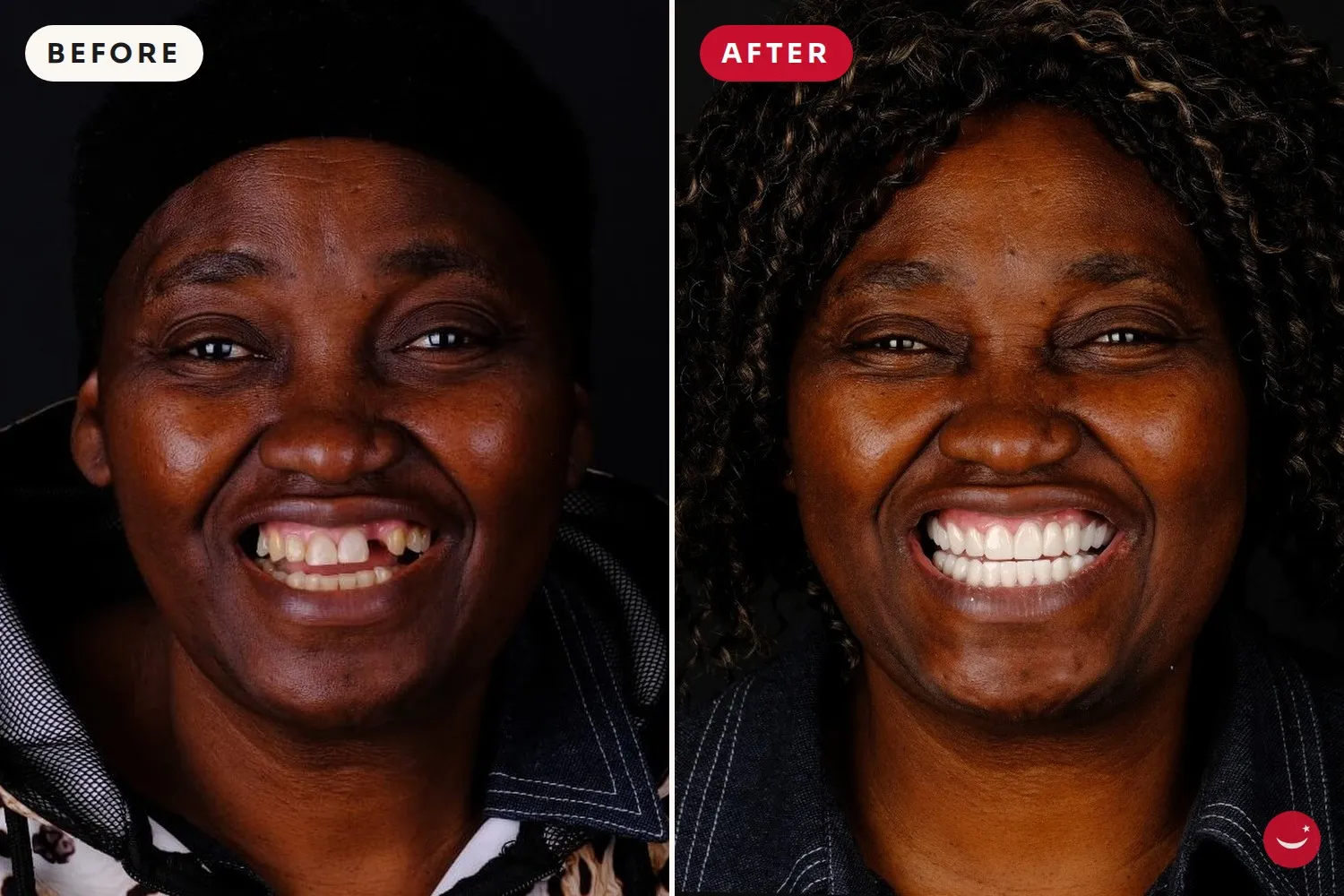 Dental Implants – before and after 6