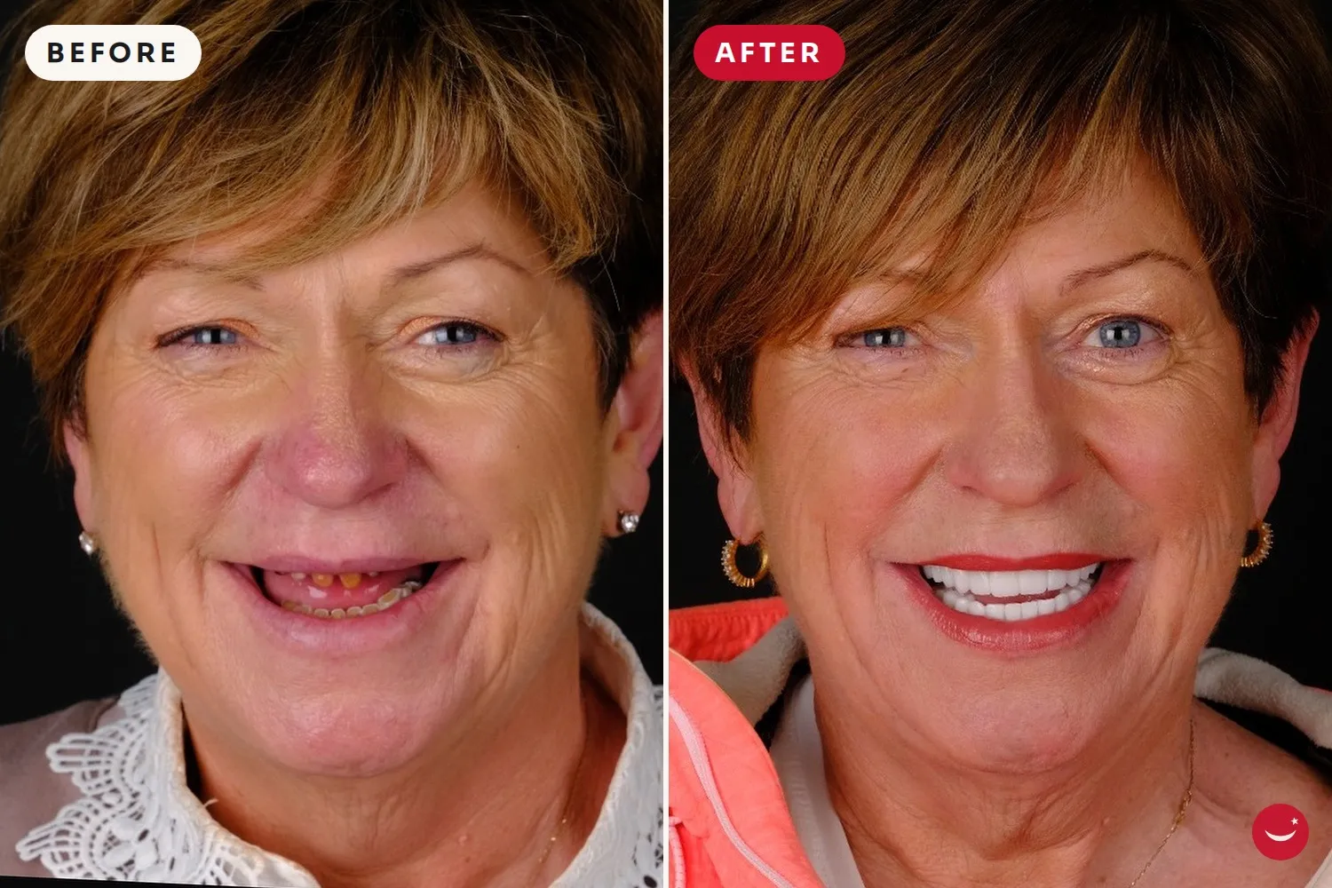 All-on-6 – before and after 9