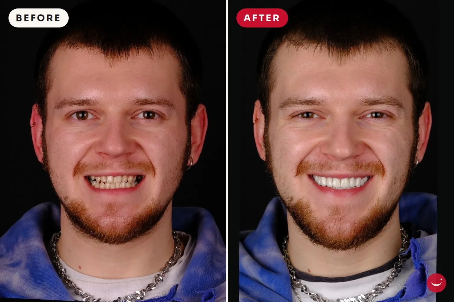 Porcelain veneers – before and after 11
