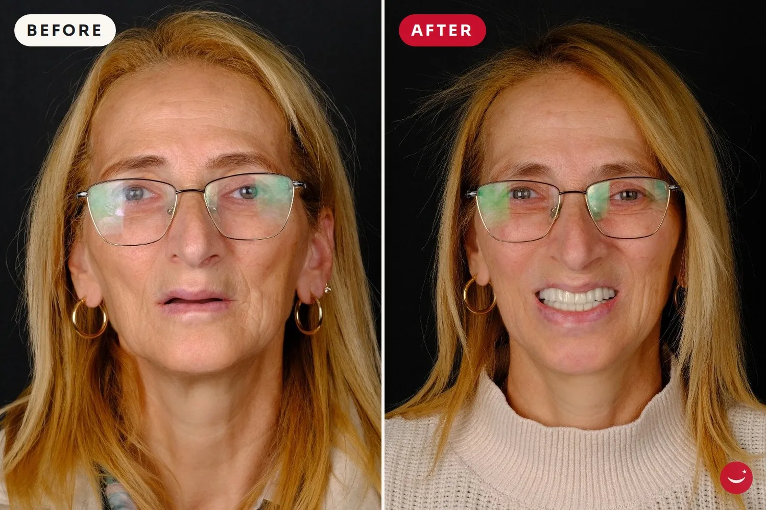 All-on-4 – before and after 8