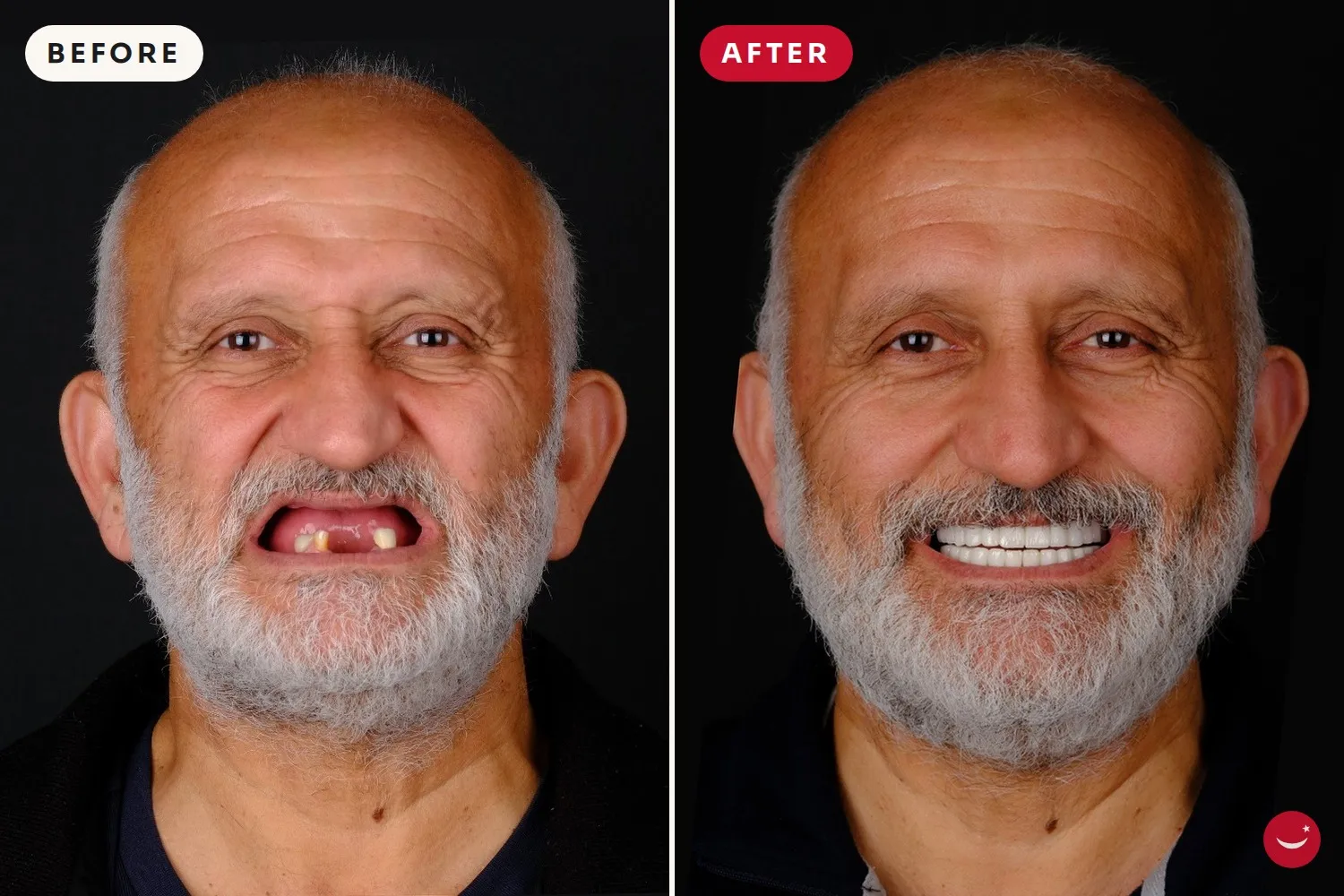 All-on-4 – before and after 7