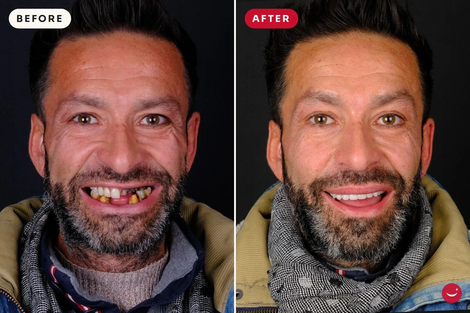 Dental Implants – before and after 5