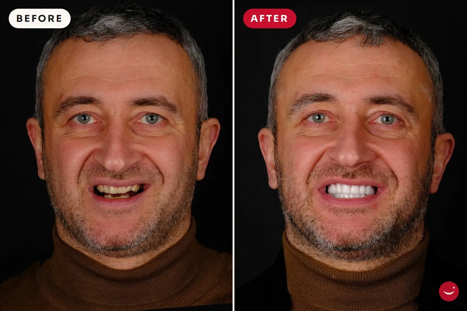 Dental Implants – before and after 4