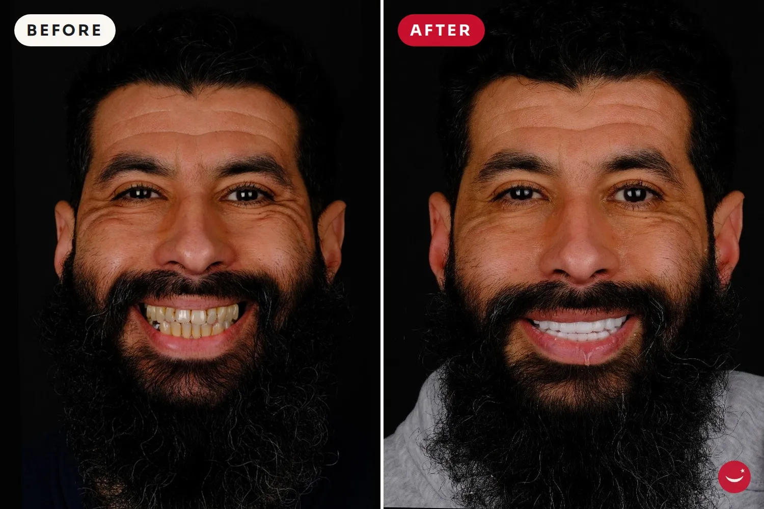 Hollywood Smile – before and after 18