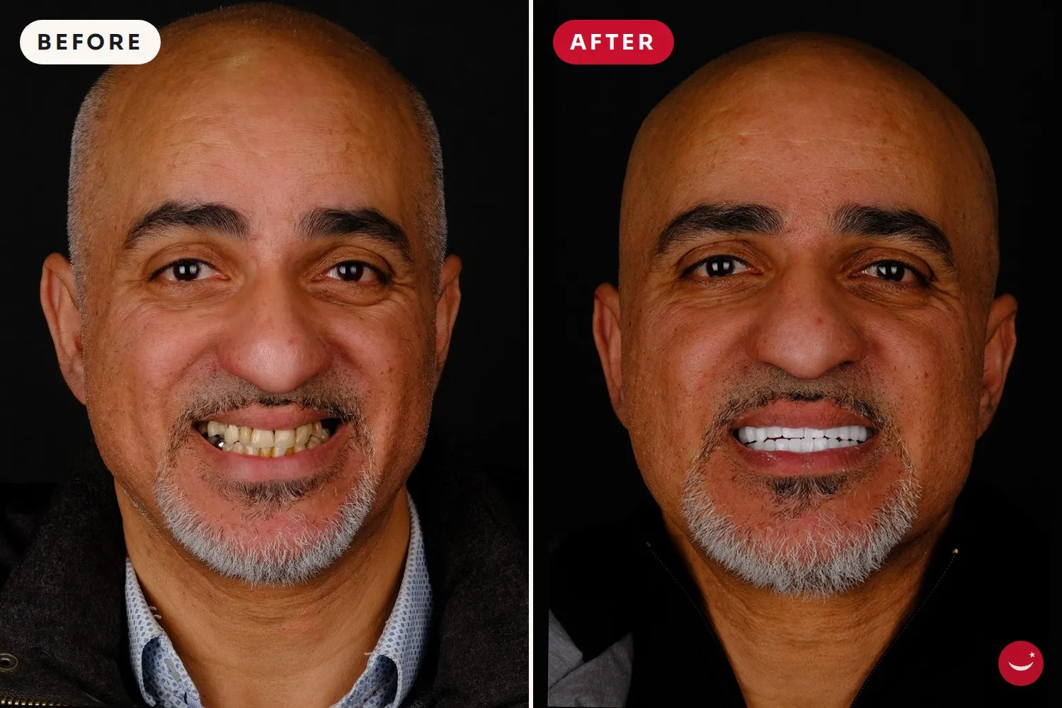 Hollywood Smile – before and after 17