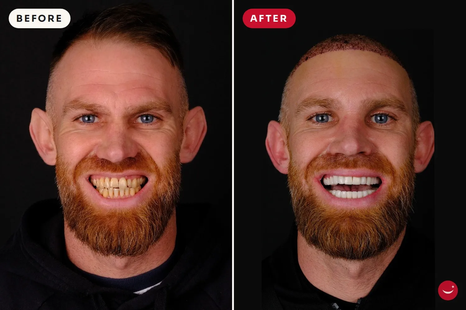 Hollywood Smile – before and after 16