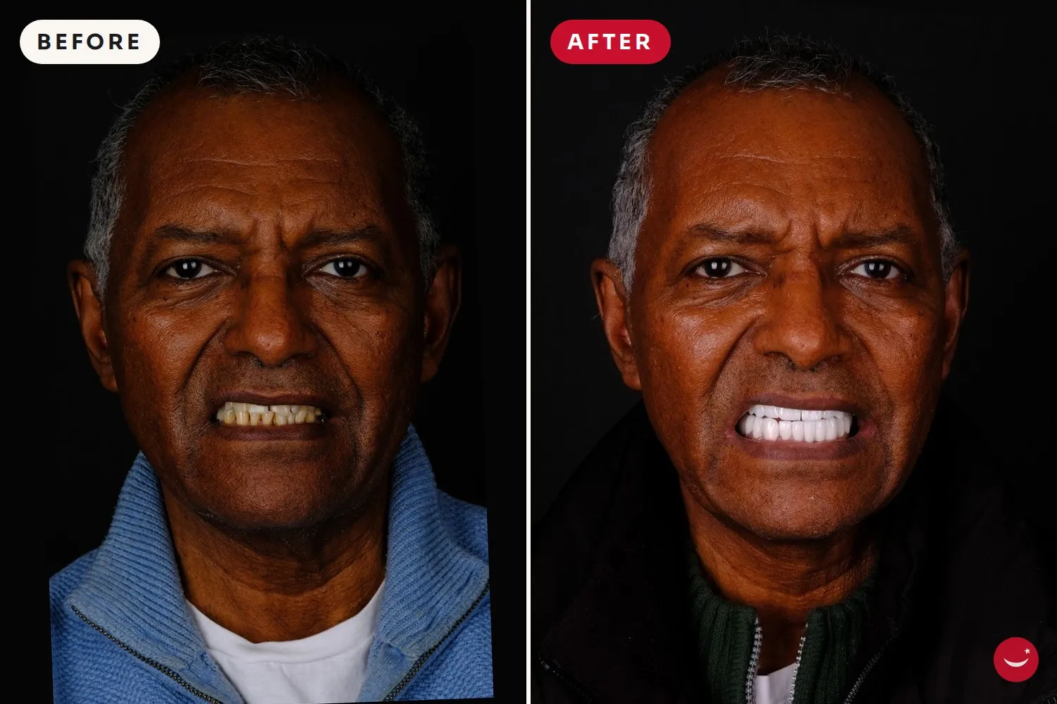 Hollywood Smile – before and after 15