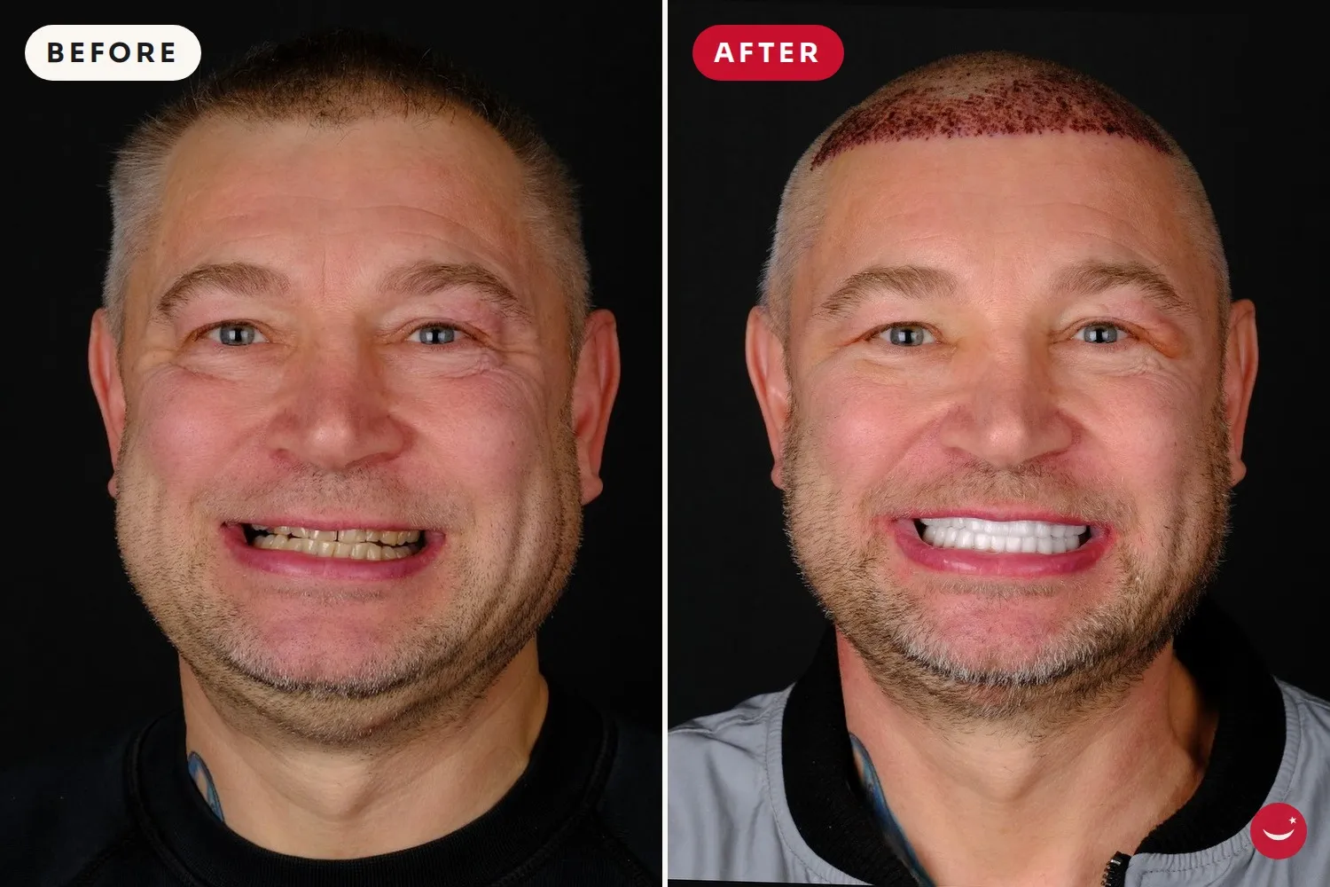 Hollywood Smile – before and after 14