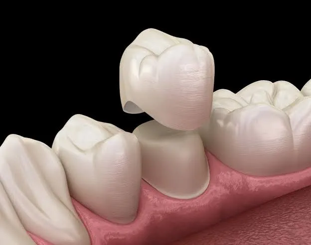 Zirconia Crowns