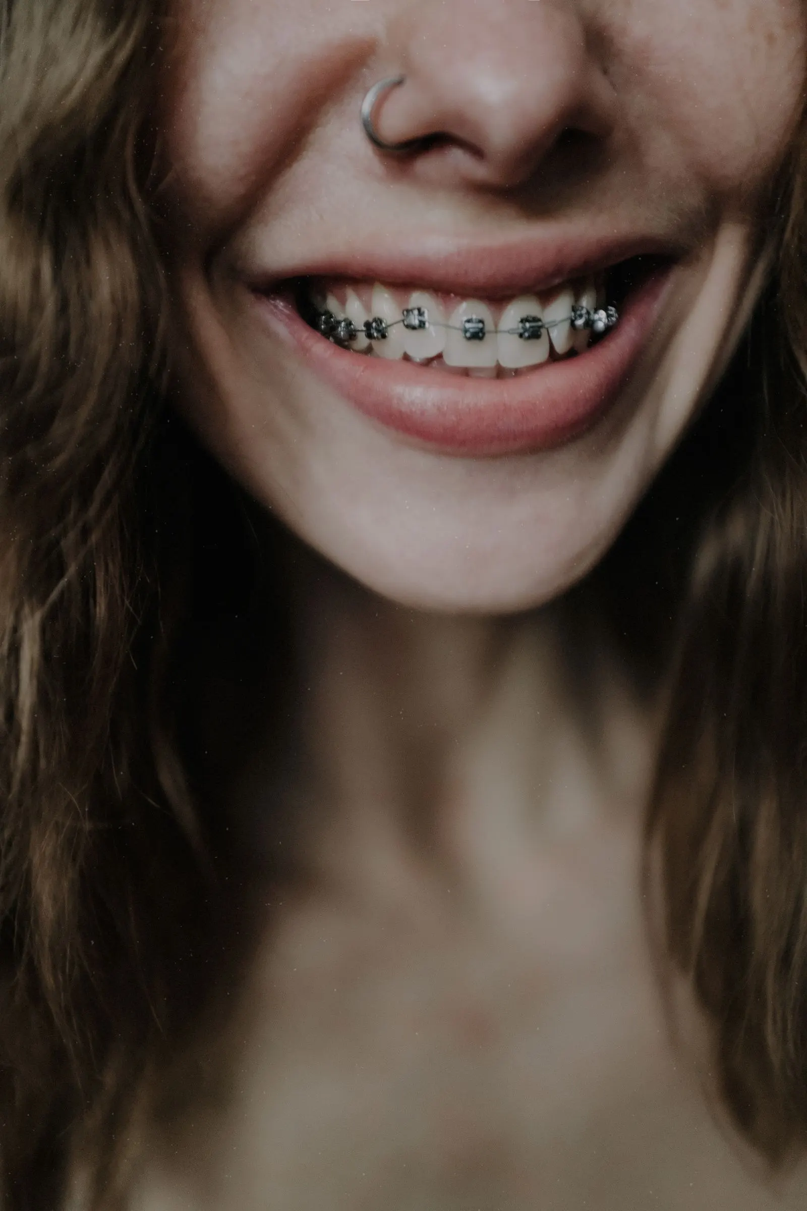 Close-up of a smile with braces