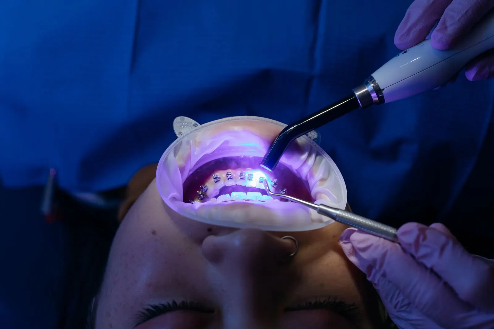 Composite Bonding in Turkey: Cost per Tooth, How It Compares to Porcelain Veneers and When It Is the Smarter Choice