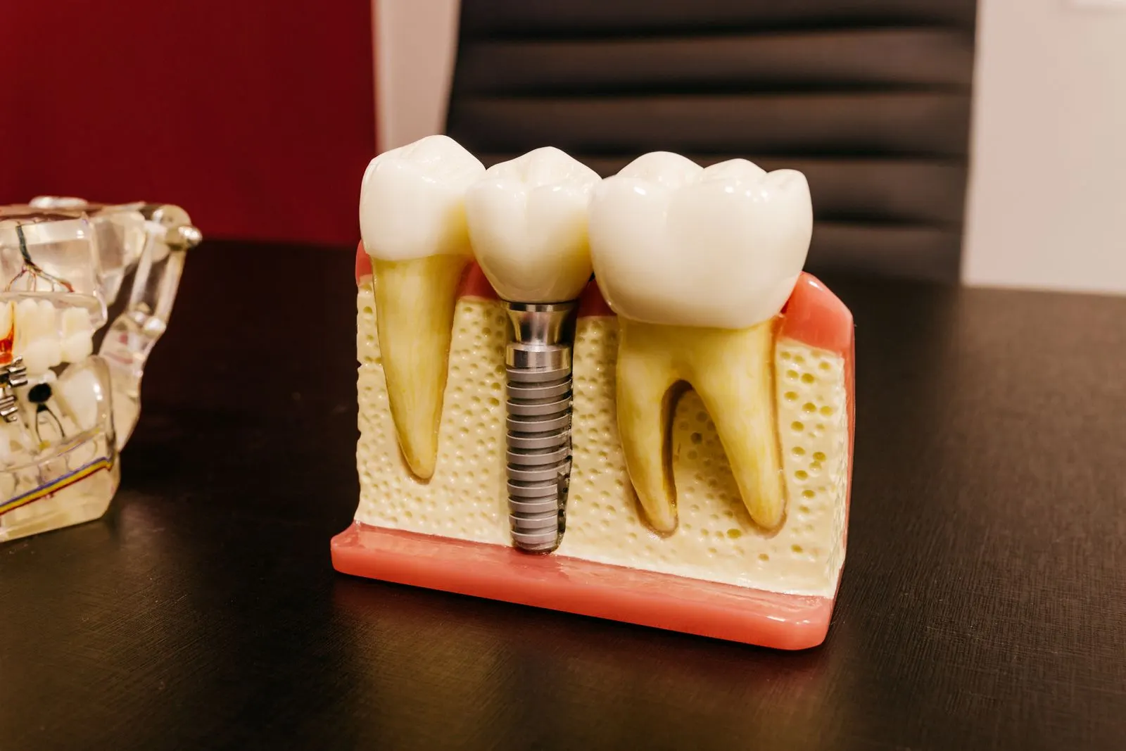 Screwless Dental Implants: What the Term Really Means