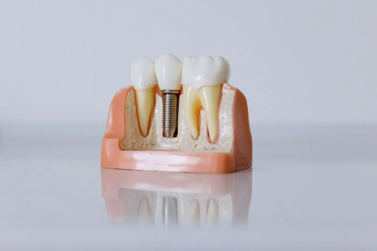 Dental implant model showing the implant in the jaw