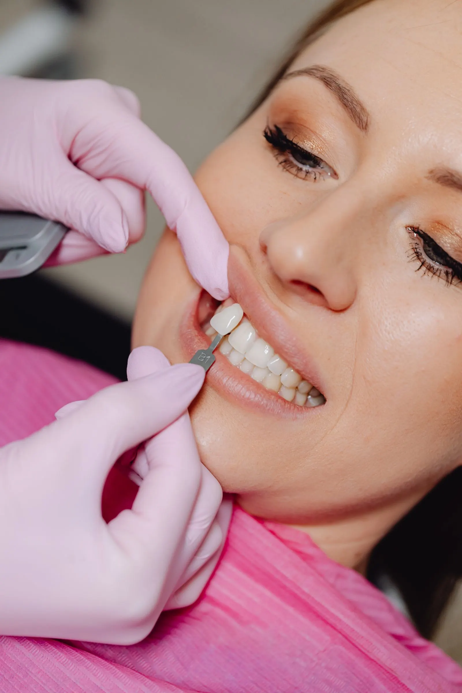 Einprobe eines Veneers in der Klinik