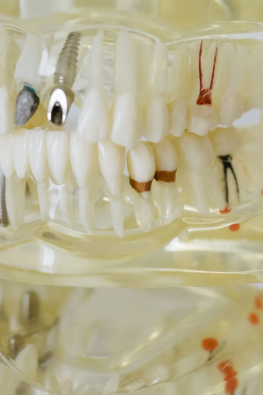Dental model showing restorative features